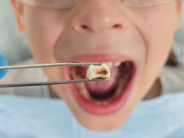 Best Emergency Wisdom Teeth Removal in Aurora, IL