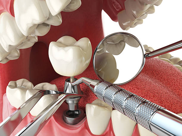 Best Emergency Root Canal Treatment in Aurora, IL